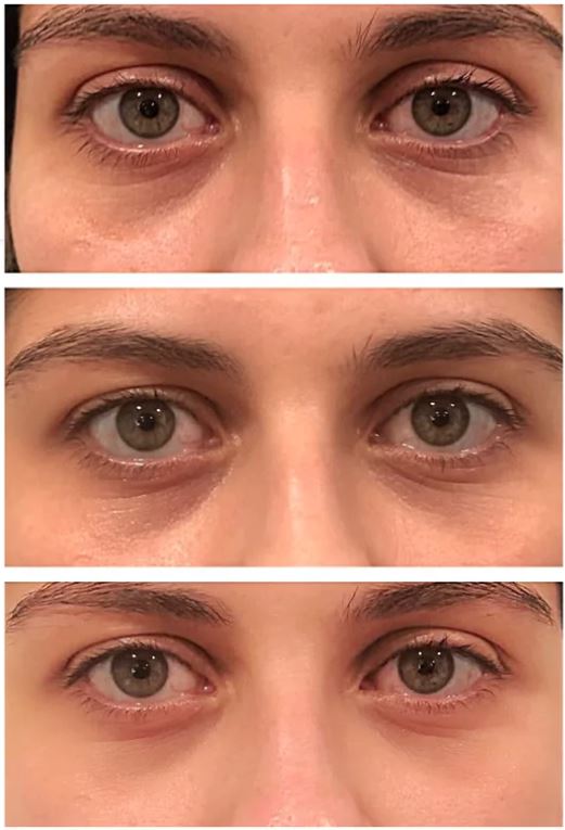 26 Year Old Woman After 20 Days