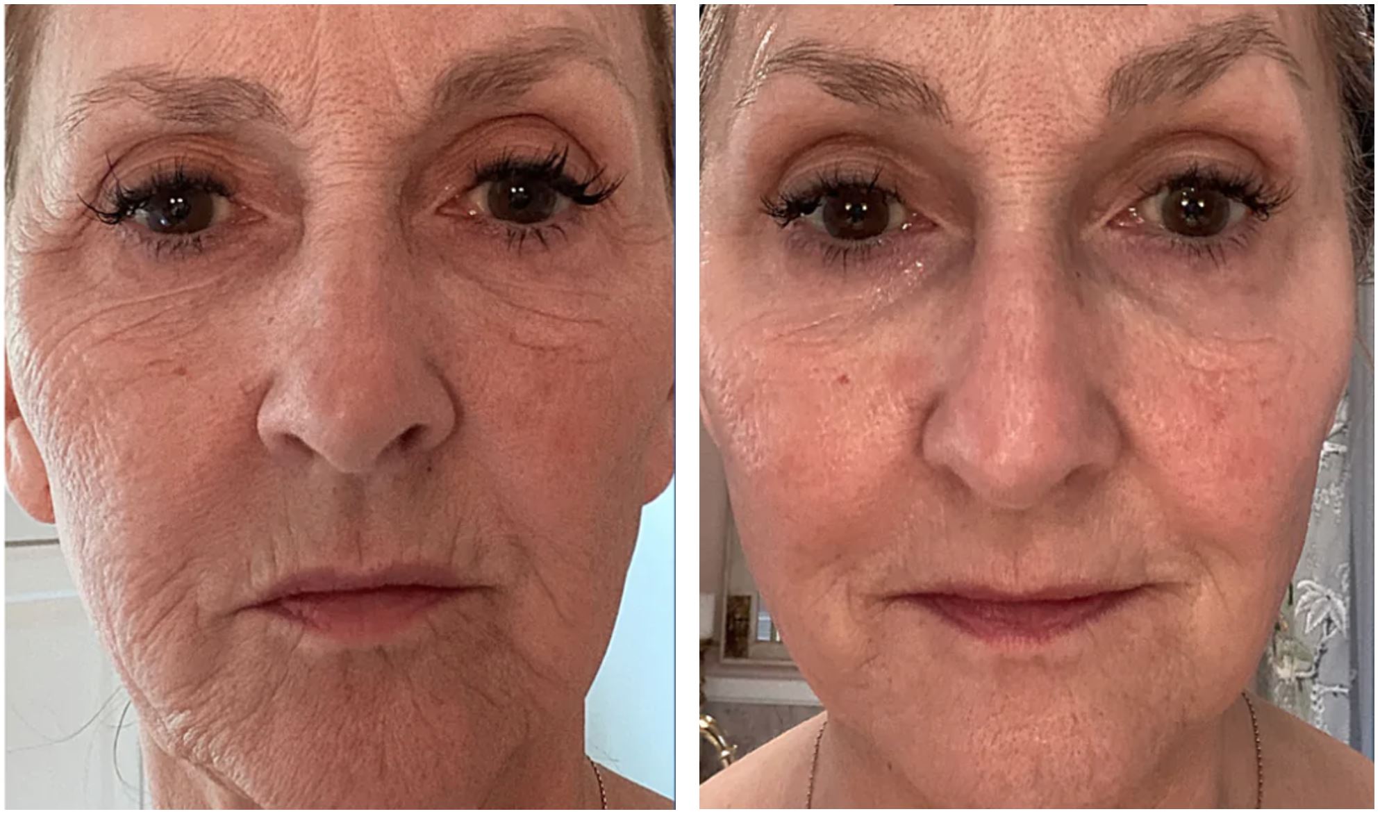 63 Year Old Woman After 20 Days