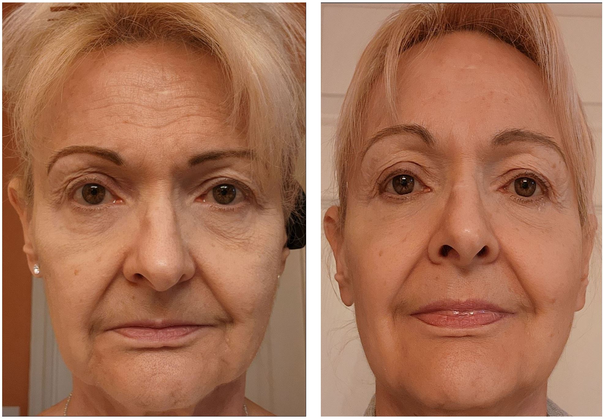 67 Year Old Woman Before and after 20 Days 2