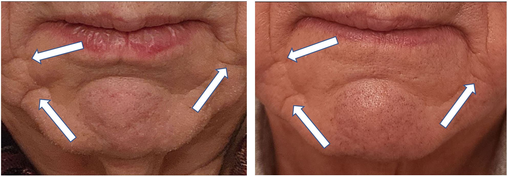 73 Year Old Man Chin