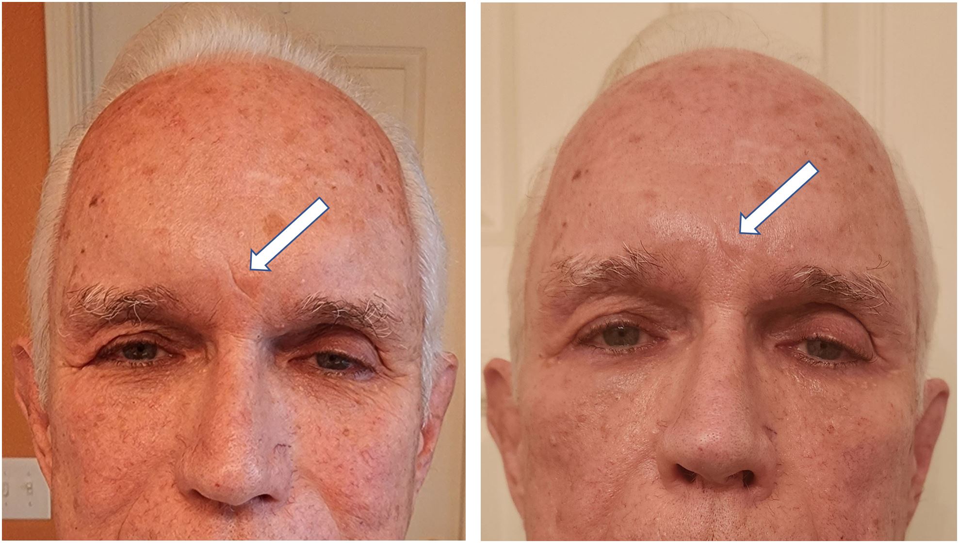 73 Year Old Man Forehead